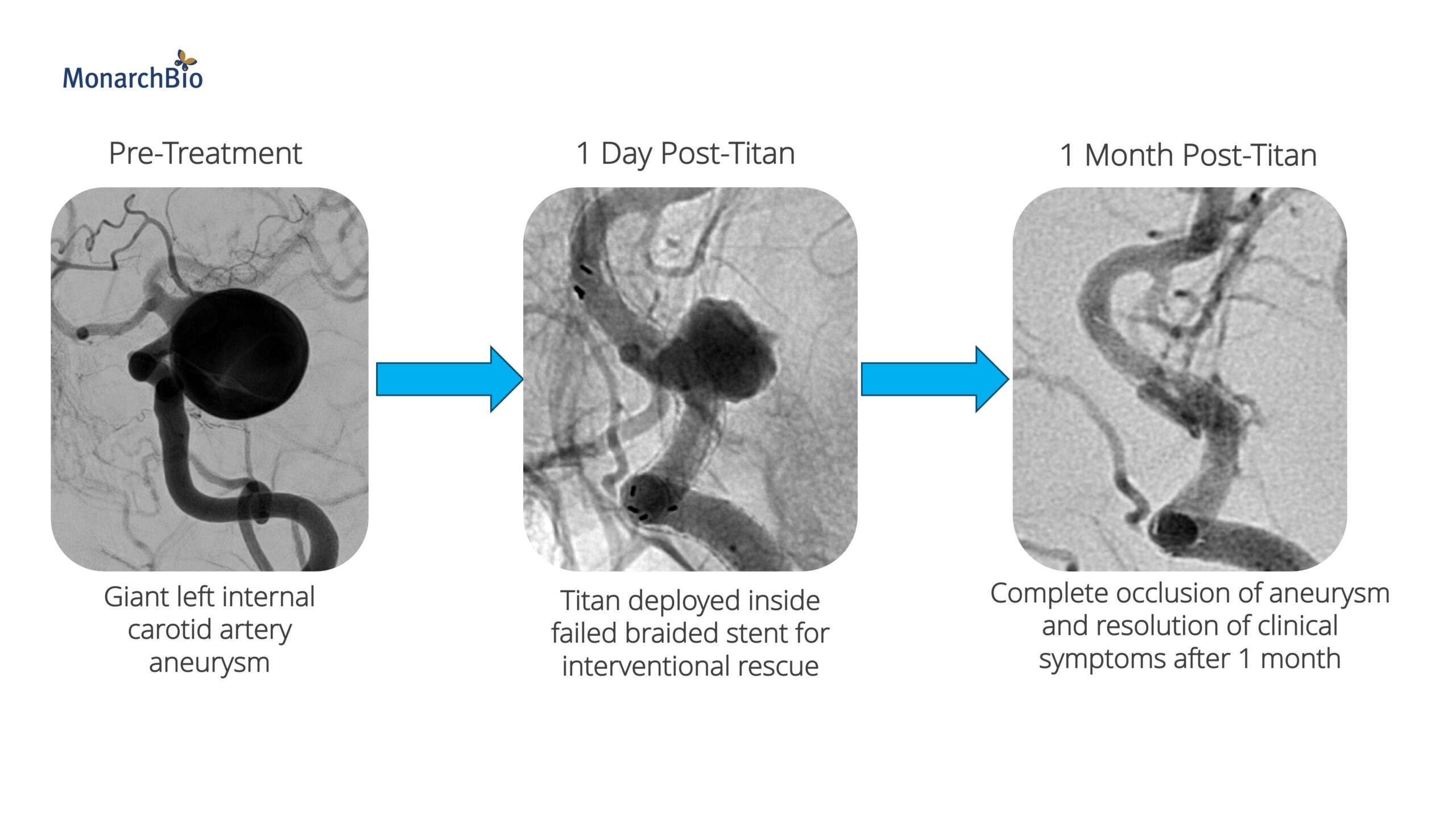 titan stent patient imaging over time